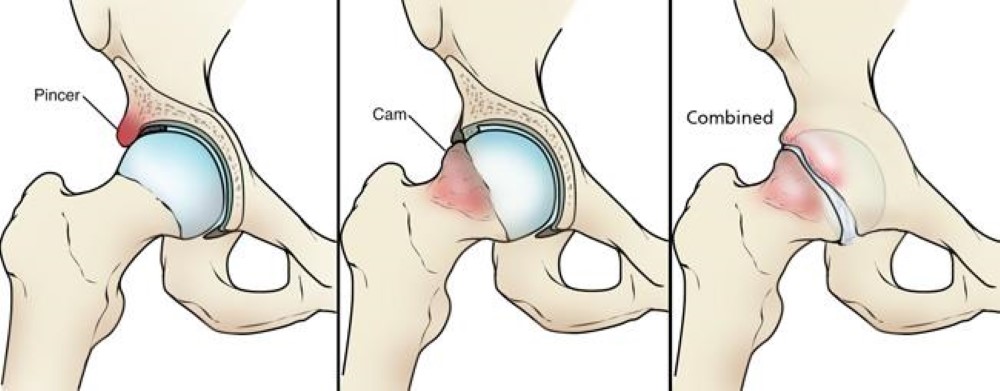 Venstre: Pincer impingement. Midten: Cam impingement. Høyre: Kombinert pincer og cam