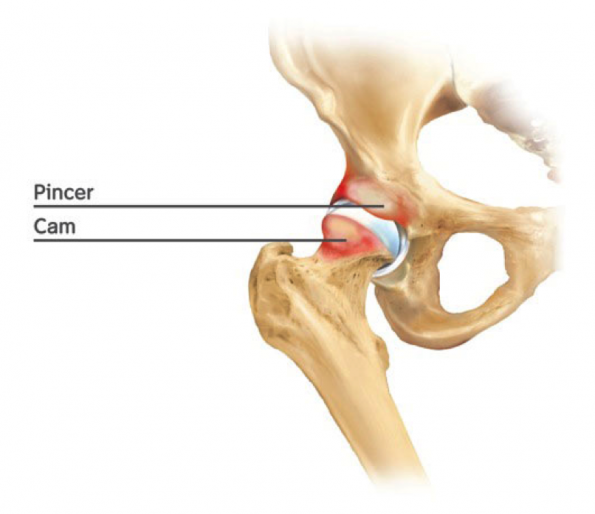 Femoroacetabular impingement (FAI)
